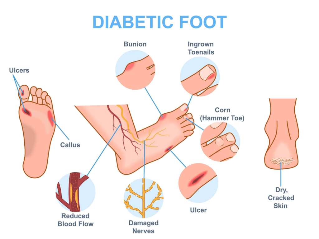 diabetic foot care